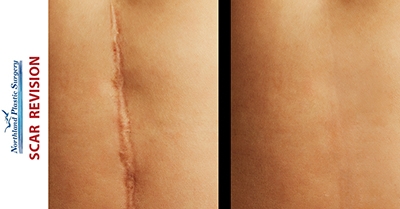 scar revision