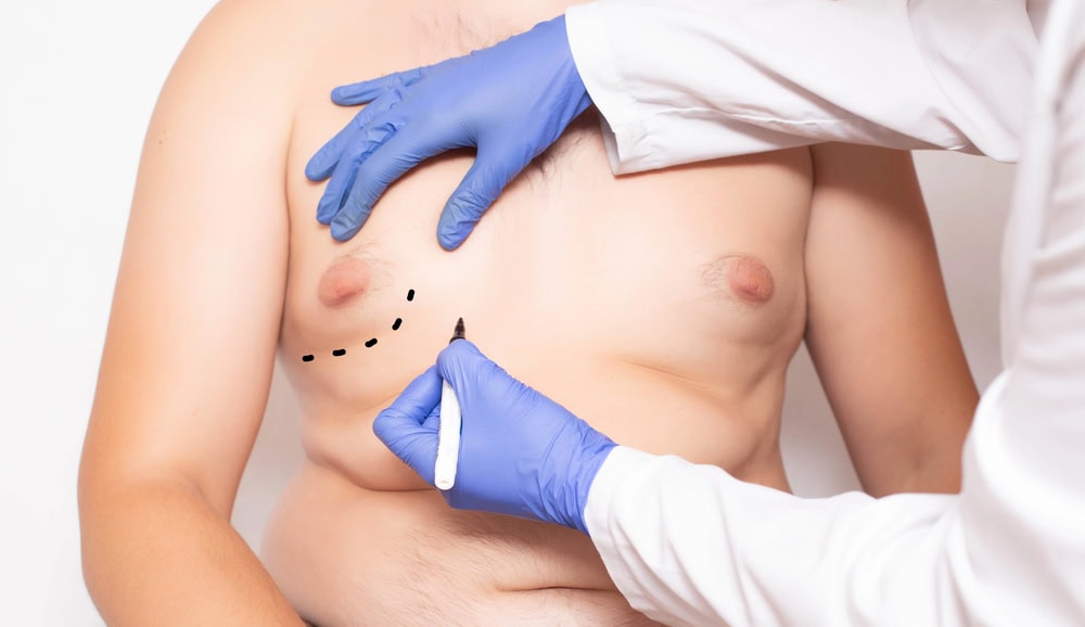 Gynecomastia surgery prep